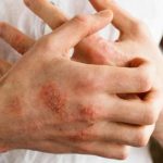 Dead Sea Salt Eczema - Natural Home Treatment and Remedy For Eczema