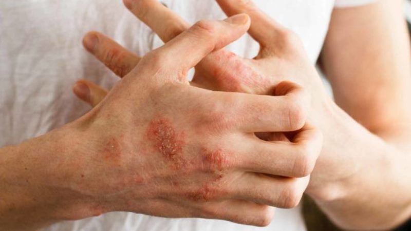 Dead Sea Salt Eczema - Natural Home Treatment and Remedy For Eczema