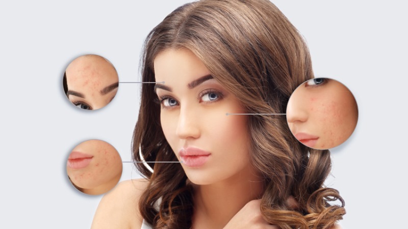 8 Tips On How To Remove Chickenpox Scars