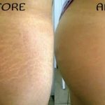 Do Stretch Marks Ever Really Disappear?