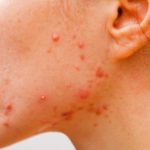 About Acne 3 Days