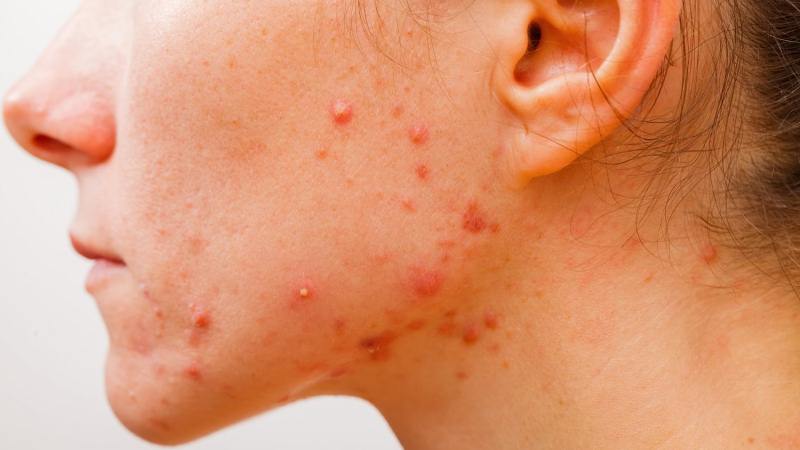 About Acne 3 Days