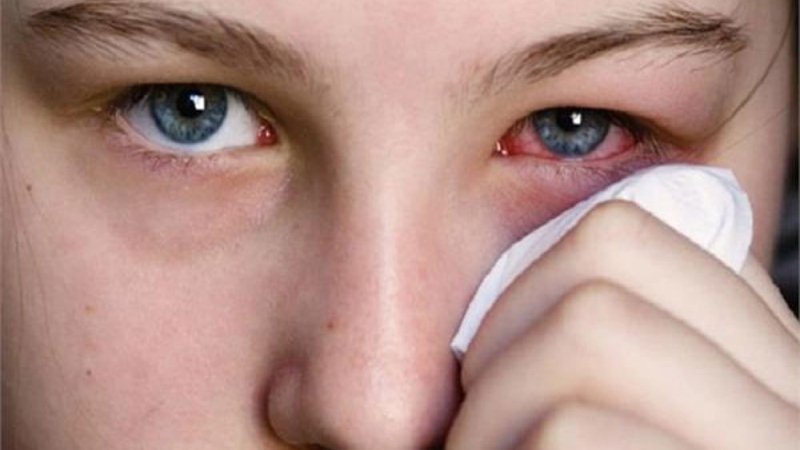 Pink Eye Symptoms